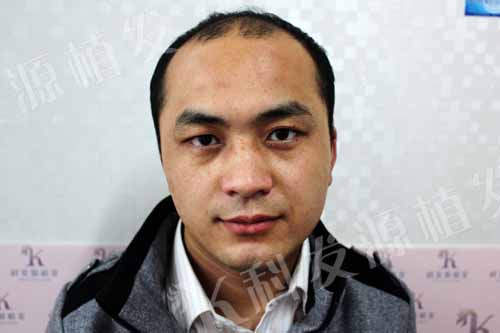 張青松：我之最 一次植發三種技術